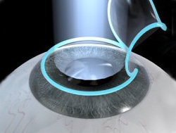 LASIK, Laser-Assisted in Situ Keratomileusis